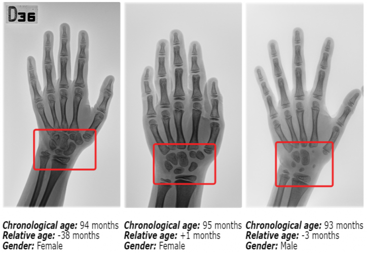 Bone Age Assessment Biomedical Computer Vision